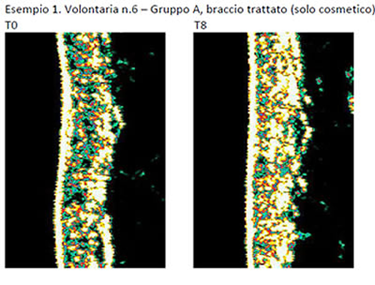 T0 e T8 del braccio trattato con il solo cosmetico