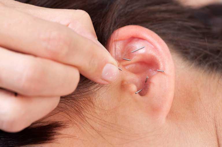 Auricoloterapia per Smettere di Fumare