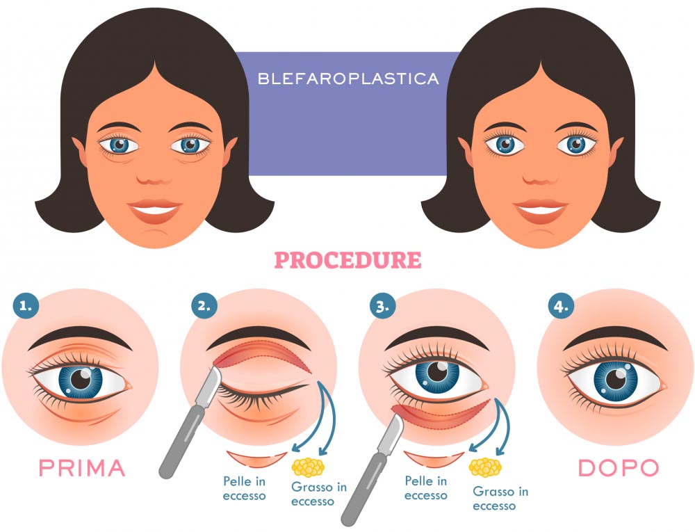 Blépharoplastie | C’est Quoi ? Procédure, Résultats, Risques