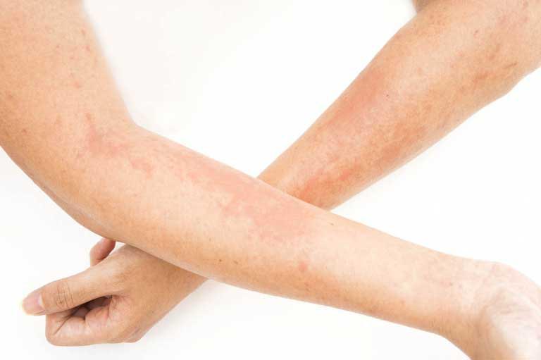 Dermatite Allergica da Contatto