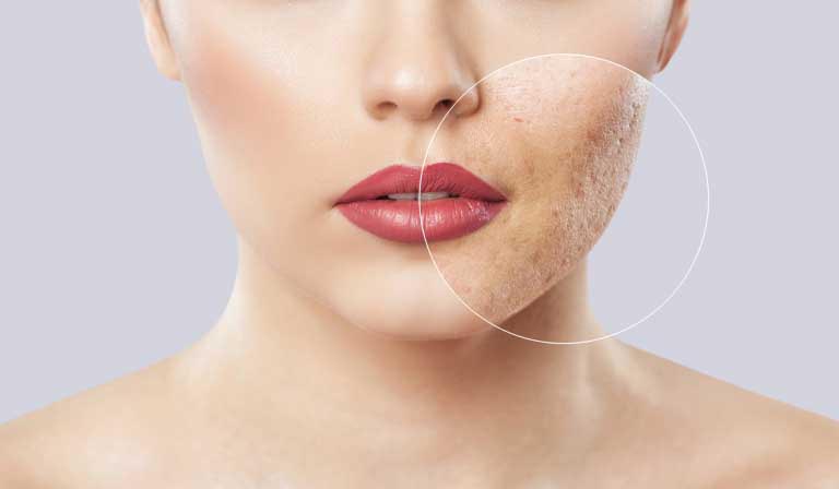 Adapalene e Acne | Efficacia, Vantaggi, Effetti Collaterali