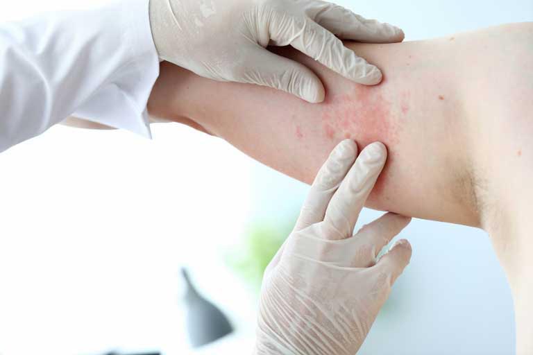 Methylisothiazolinone | Cos’è? Fa Male? Usi e Allergie