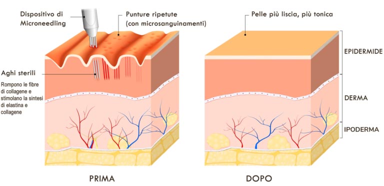 Microneedling | Funziona? Efficacia, Rischi, Svolgimento