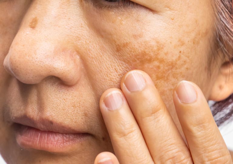 Melasma: Cause, Rimedi e Come Eliminare le Macchie Scure dal Viso