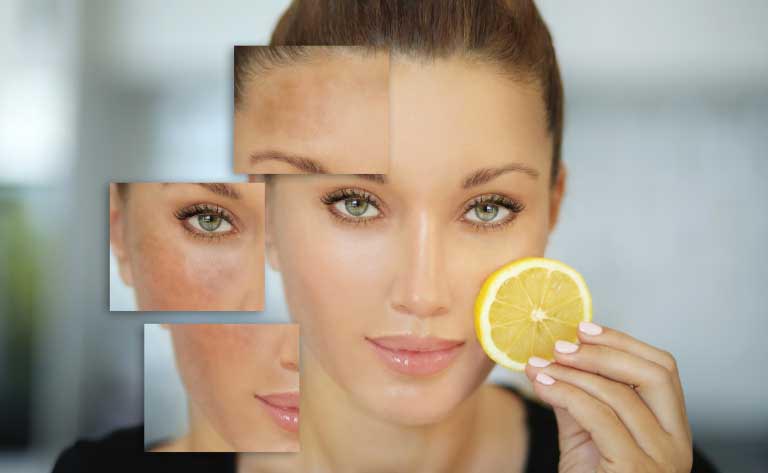 Melasma: Cause, Rimedi e Come Eliminare le Macchie Scure dal Viso