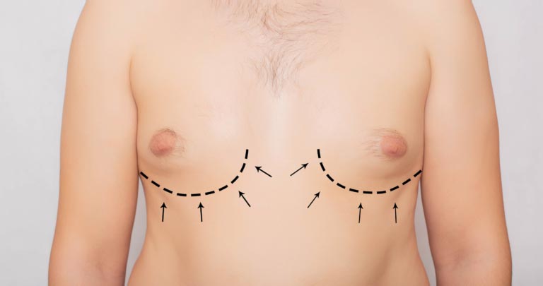 Ginecomastia | Cause, Cure | Come Aumentare il Testosterone