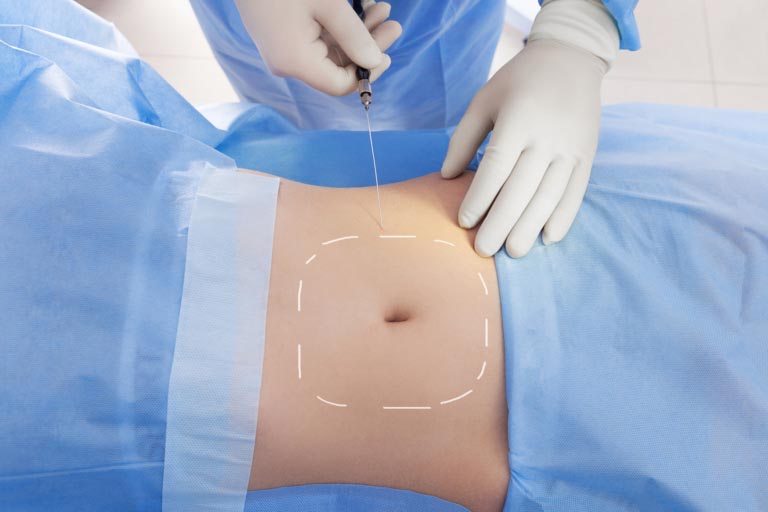 Liposuzione Laser | Risultati, Prezzo, Come Funziona