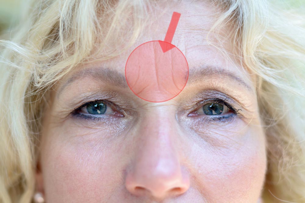 Zornesfalten | Ursachen | Botox, Filler, Wirksame Hilfsmittel