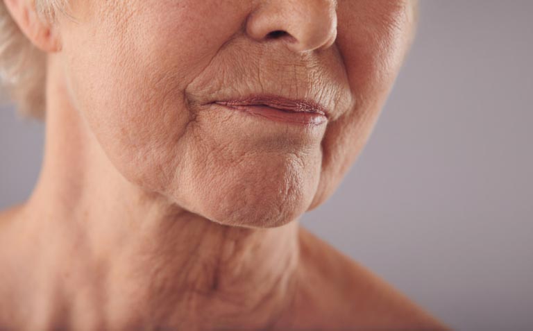 Plis d’Amertume | Causes et Traitements Efficaces