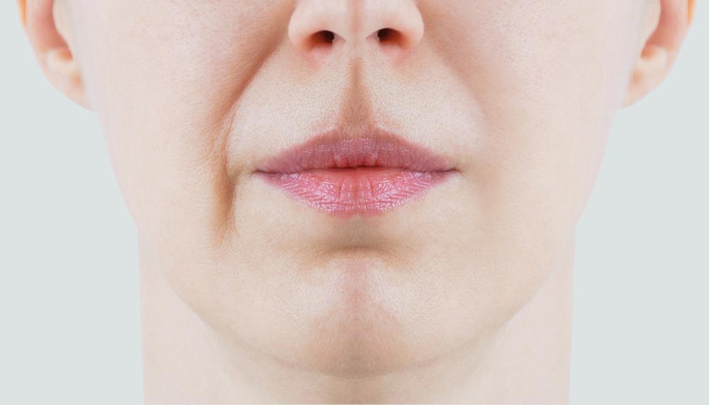 Sillons Nasogéniens | Causes | Fillers, Botox, autres Traitements