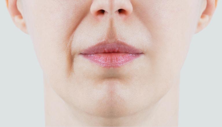 Rughe Nasolabiali | Cause | Filler, Botox, altri Trattamenti