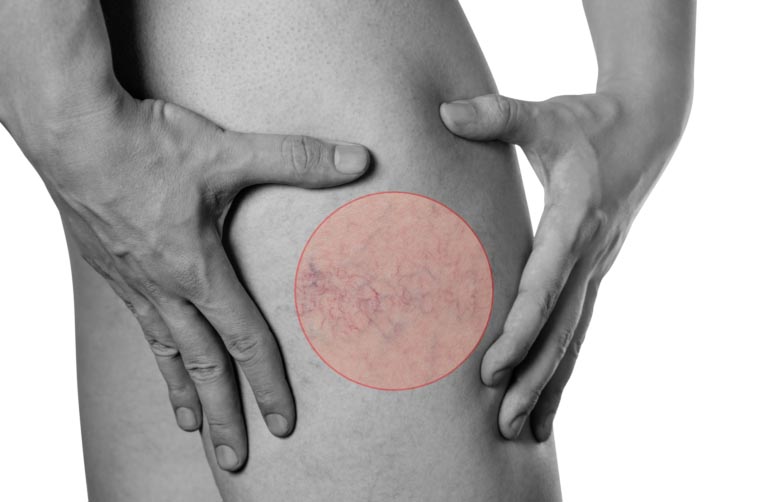 Capillari Gambe | Perché si Rompono? Trattamenti Efficaci