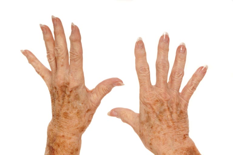 Macchie delle Mani | Cause, Creme e Trattamenti Efficaci