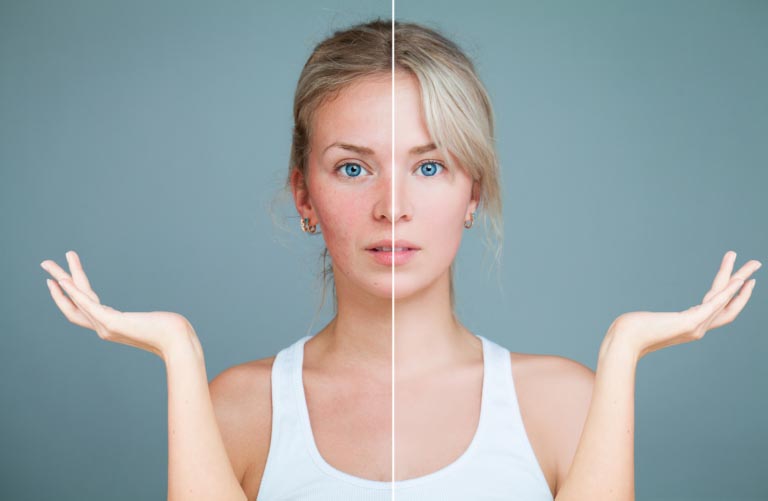 Rosacea | Cause, Sintomi, Tipi | Trattamenti e Consigli
