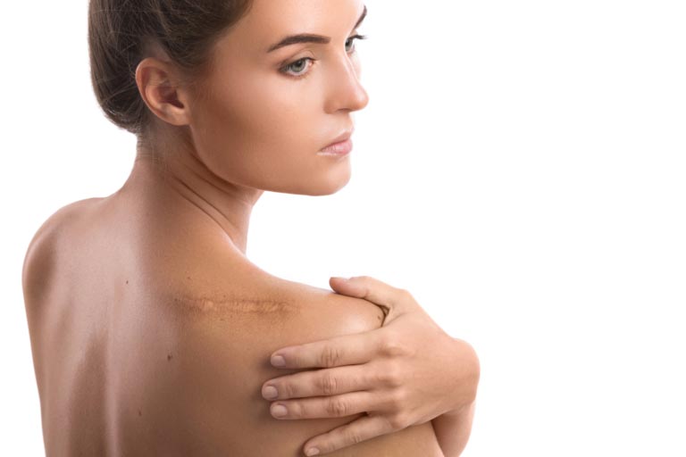 Cheloidi | Cosa Sono? Sintomi, Cause, Cure Efficaci