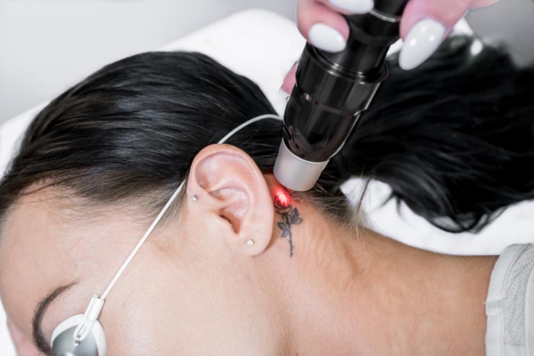 Rimozione Tatuaggi Laser | 14 Cose da Sapere