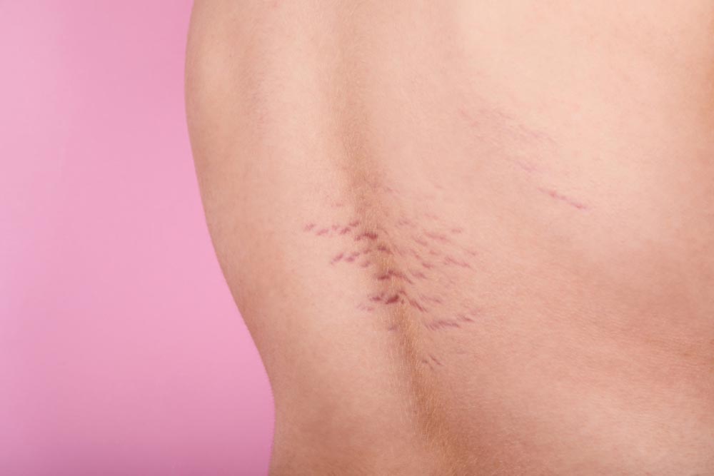 Vergetures rouges | Causes, symptômes et traitements efficaces