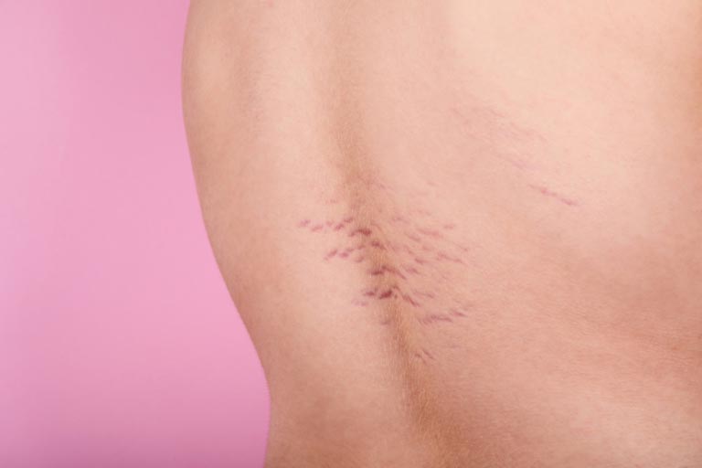 Smagliature Rosse | Cause, Sintomi, Trattamenti Efficaci