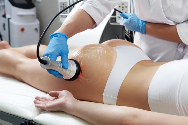 Cavitazione Medico-Estetica | Risultati, Prezzo | Come Funziona