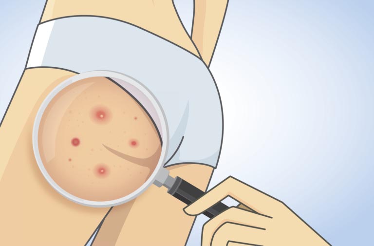 Follicolite | Cause, Sintomi | Prevenzione e Trattamento