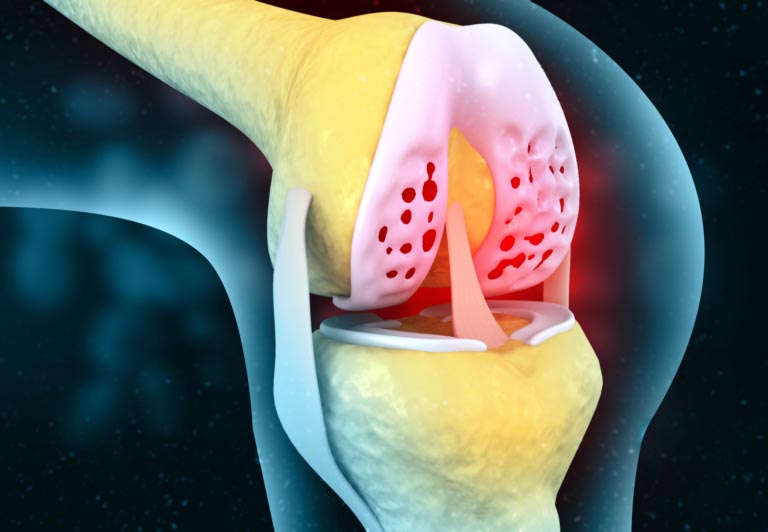 Condroitina | Condroitin Solfato | Dosi, Benefici, Efficacia