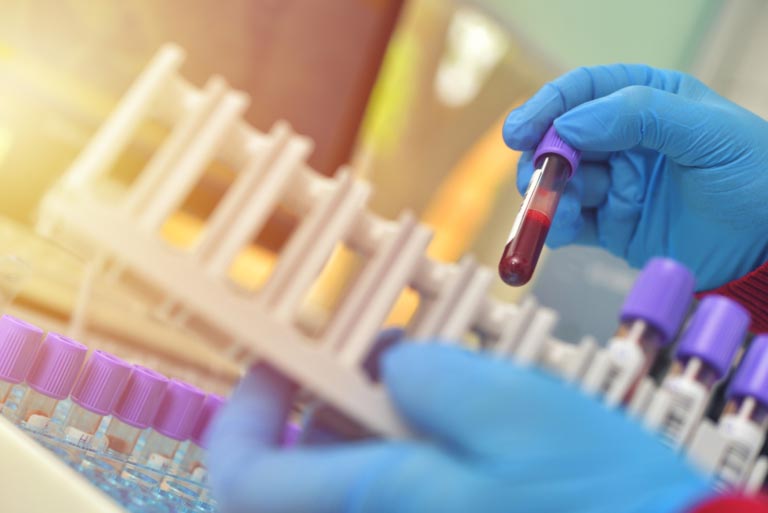 Acido Urico Alto | Iperuricemia | Cause | Come Abbassarlo