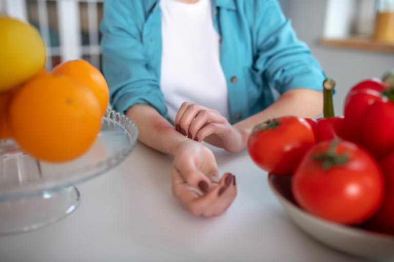 Dieta per Orticaria | Cosa Mangiare | Cibi da Evitare