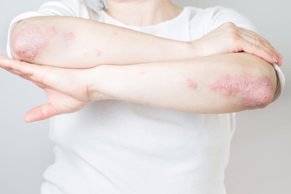 Psoriasi | Cos’è? Cause, Sintomi, Immagini e Cure