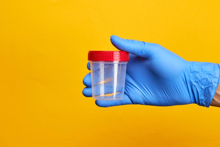 Leucociti Alti nelle Urine | Cause, Sintomi, Rimedi