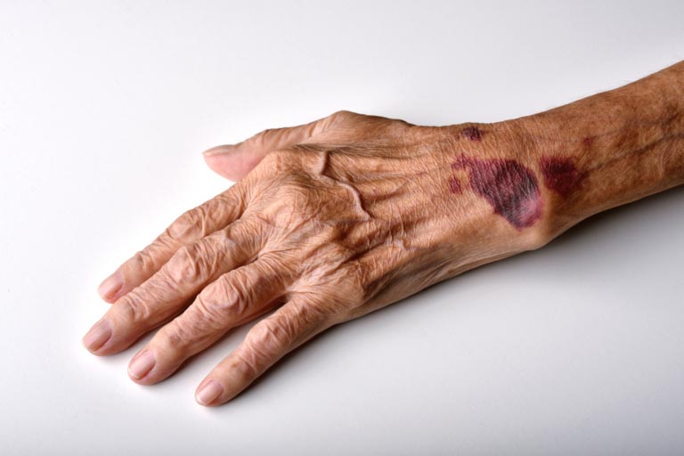 Dermatoporosi | Cos’è | Sintomi, Cause, Cure Efficaci