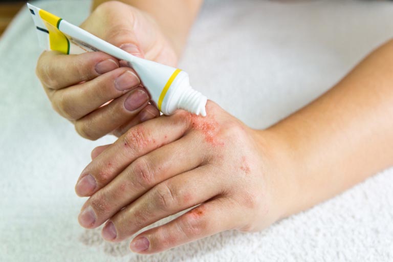 Creme Dermatite Atopica | Cosa Contengono, Come Sceglierle
