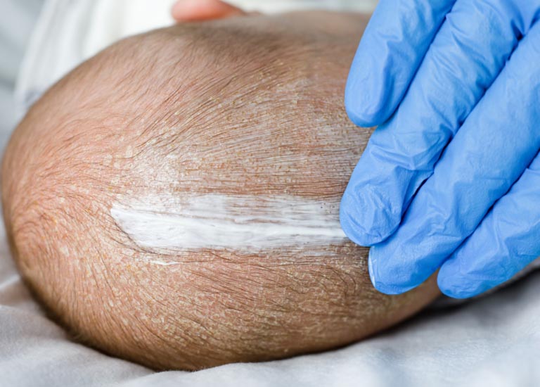 Crema per Dermatite Seborroica Efficace | Come Sceglierla?