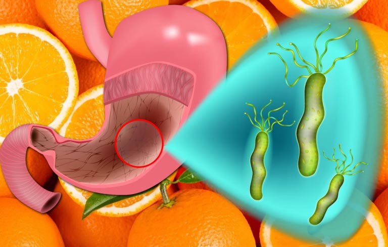 Vitamine C e D contro Helicobacter Pylori | Dosi, Benefici, Consigli