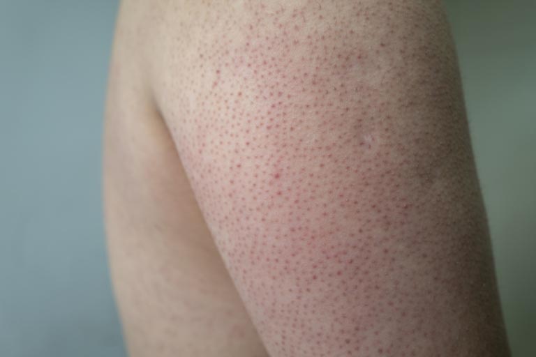 Cheratosi Pilare | Cause, Sintomi | Le Cure più Efficaci