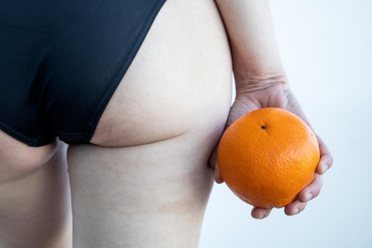 Pelle a Buccia d’Arancia | Cosa Fare? Cause e Cure Efficaci
