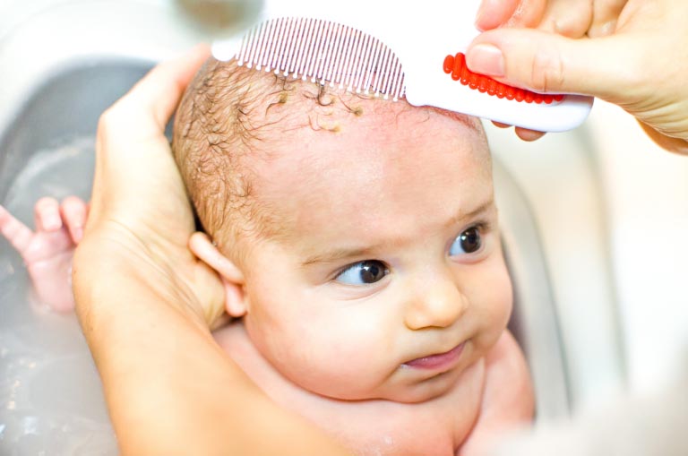 Crosta Lattea | Cause, Sintomi, Cure | Cosa Fare? Consigli