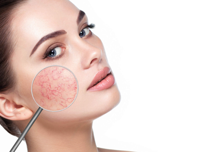 Pulsed Dye Laser in Dermatologia | Benefici e Controindicazioni