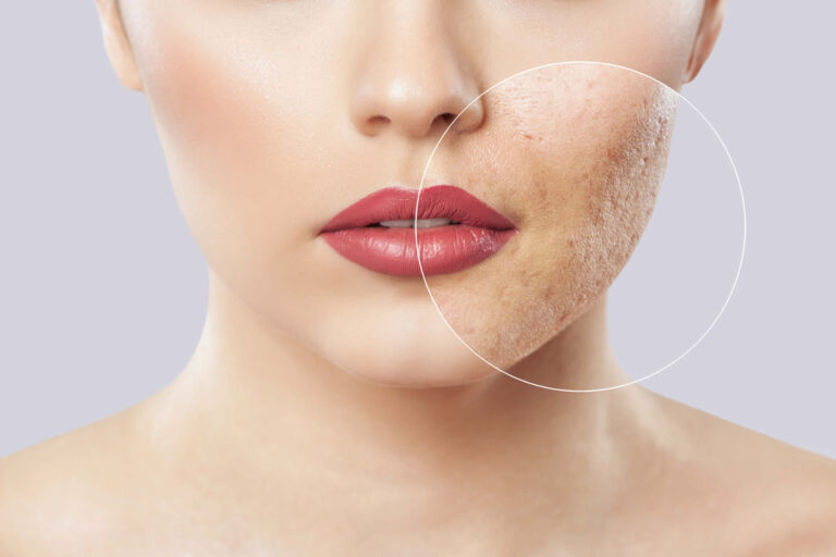 Cicatrici da Acne | Cause, Tipi | Trattamenti Efficaci per Eliminarle