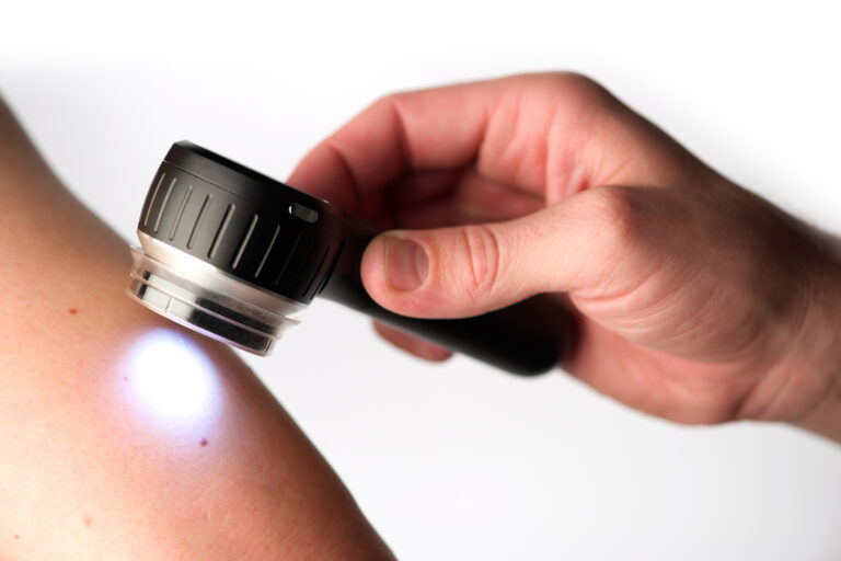 Dermatoscopia | A Cosa Serve, Come si Esegue, Perché è Importante