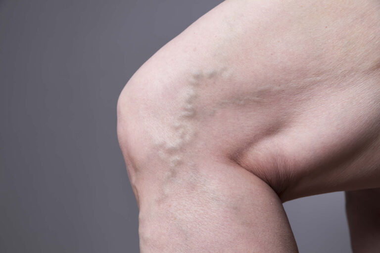 Rimedi Vene Varicose | Farmaci, Integratori, Calze, Chirurgia
