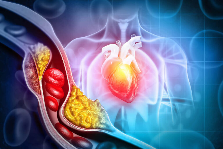 Aterosclerosi | È reversibile? Si può Guarire? Dieta e Farmaci