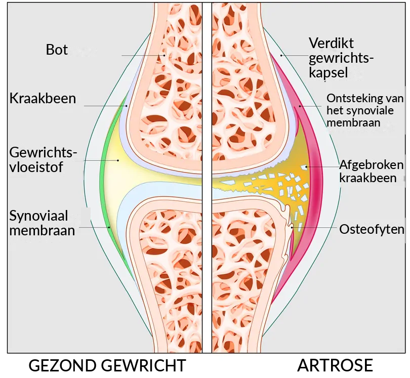 Artrosi