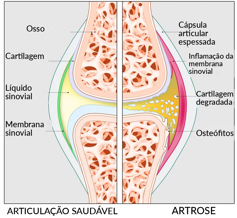 Artrosi