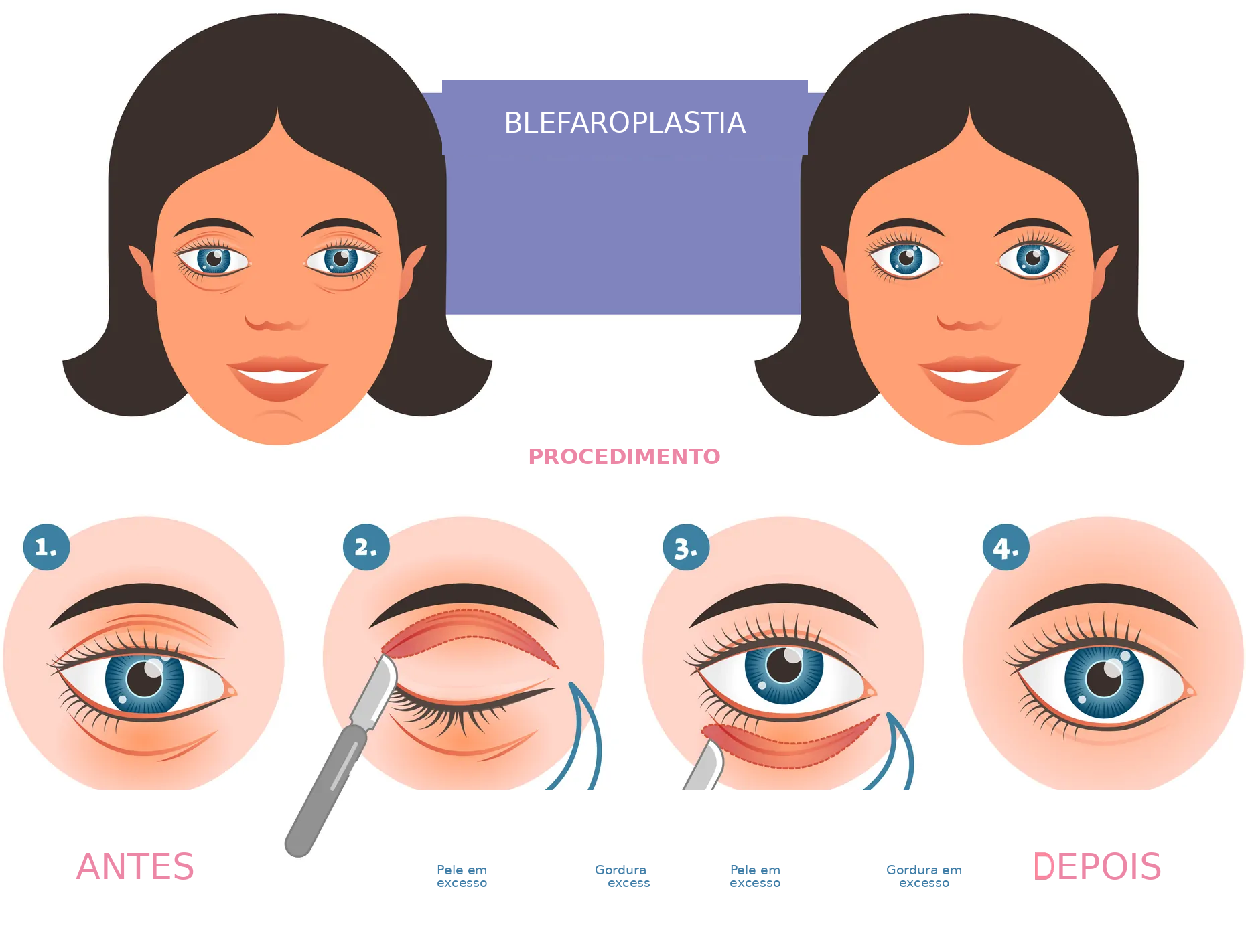 Cirurgia de blefaroplastia das pálpebras