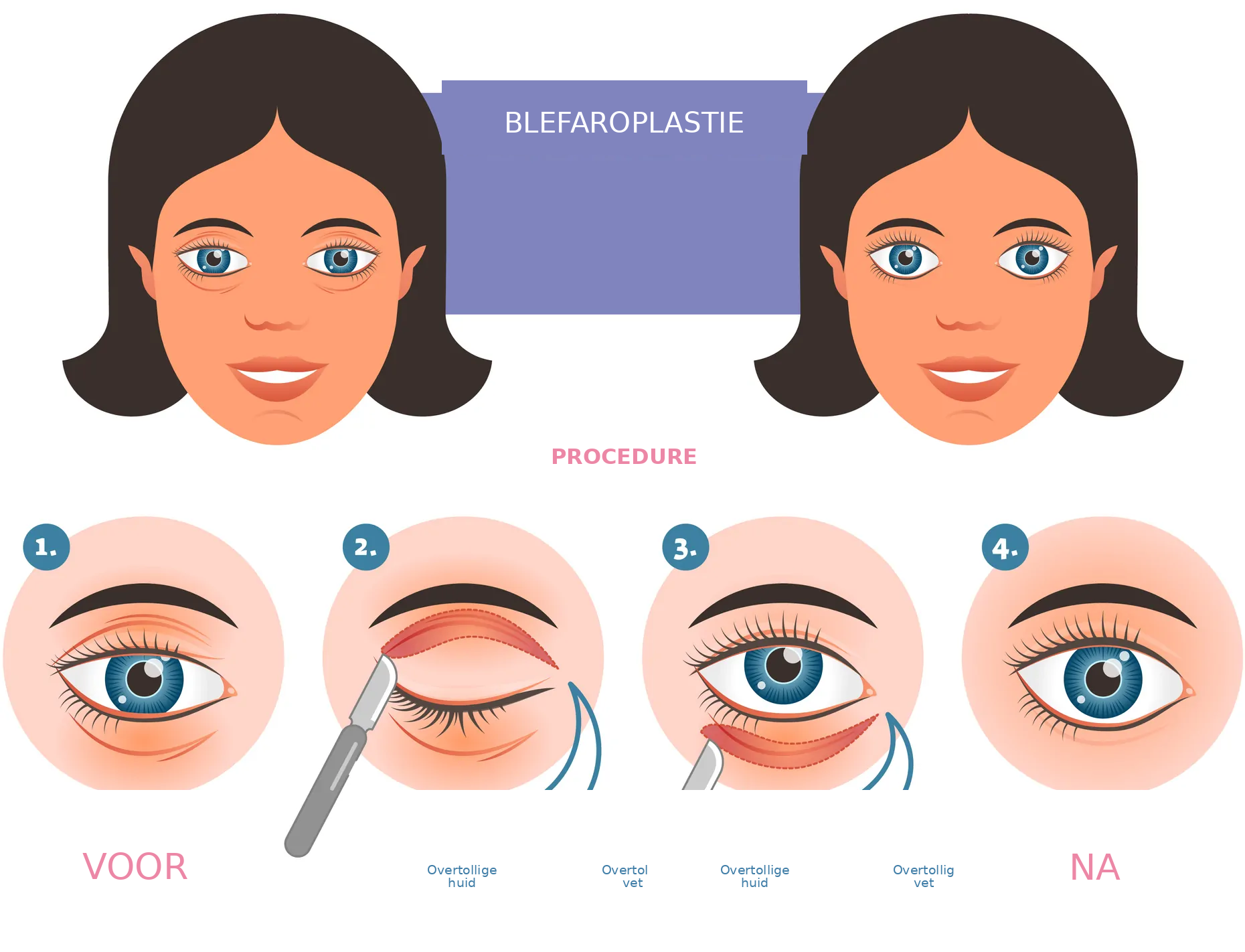 Blefaroplastiek en ooglidcorrectie