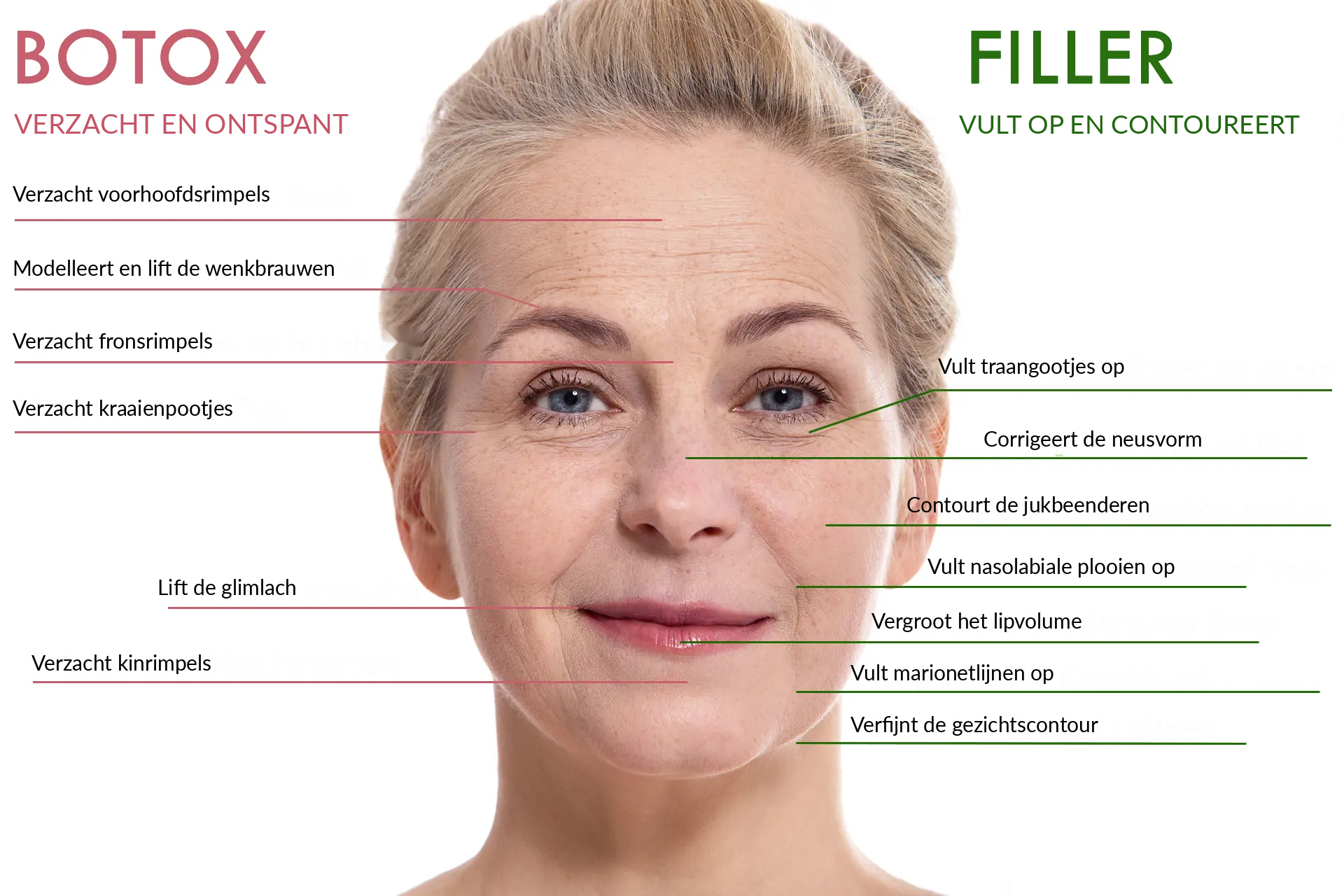 Verschillen tussen botulinetoxine en fillers