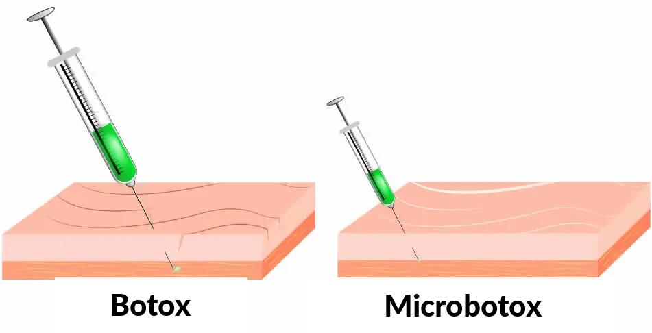 Microbotox en Botox