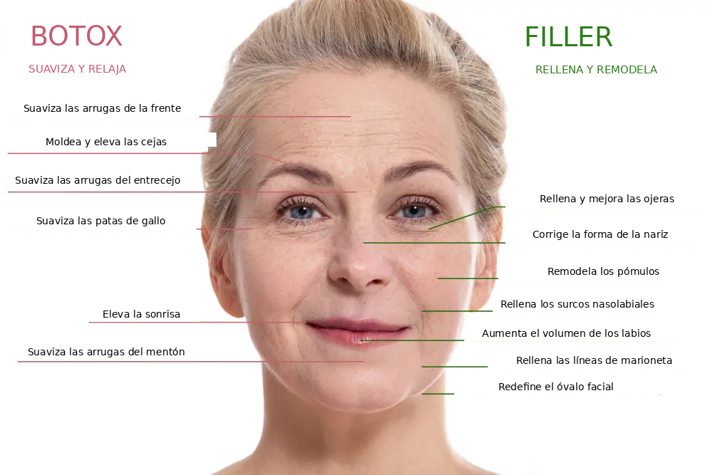 Rellenos o toxina botulínica