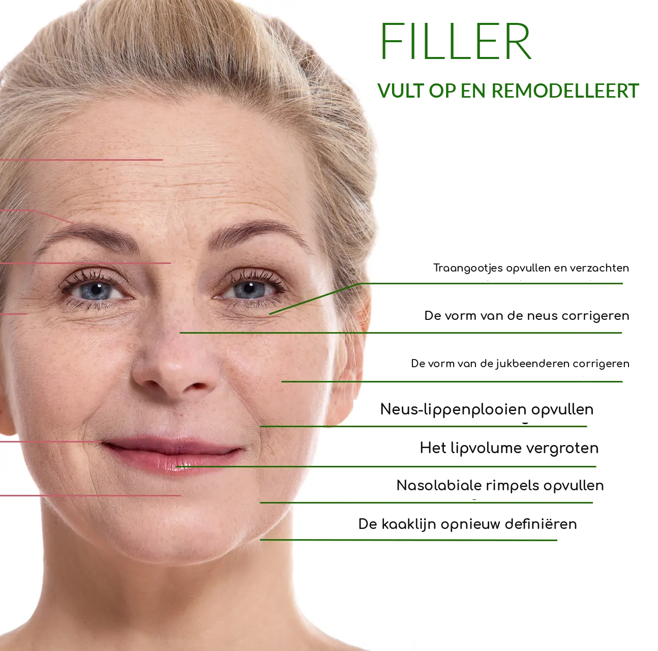 Indicaties voor fillers
