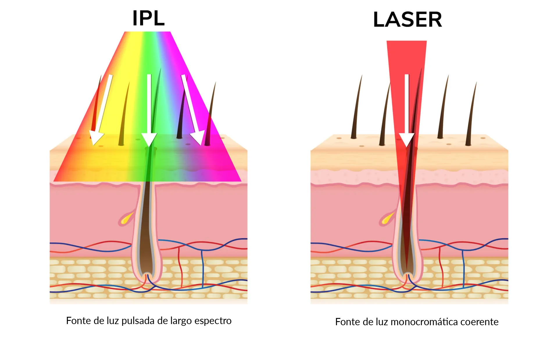 Laser e luz pulsada